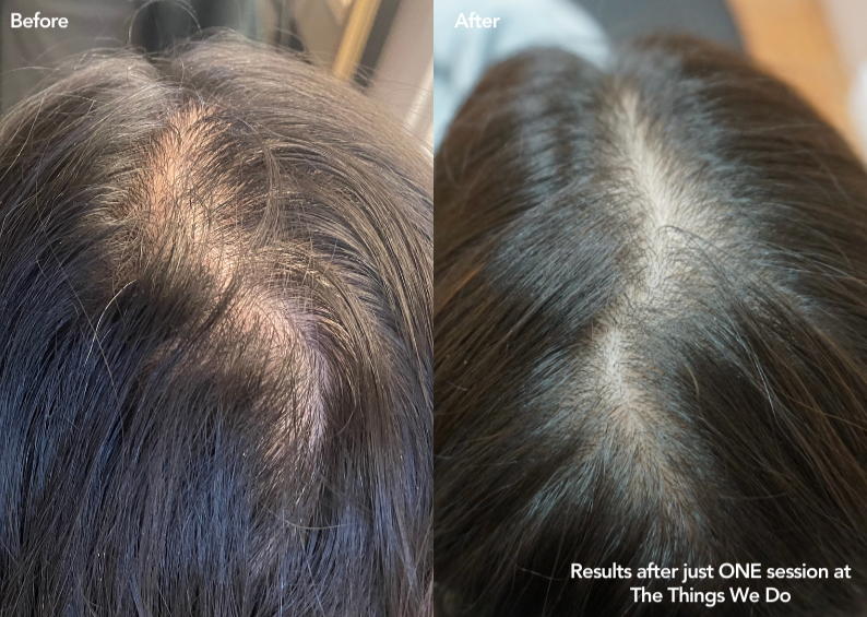 PDGF+ Hair Restoration (1 session)
