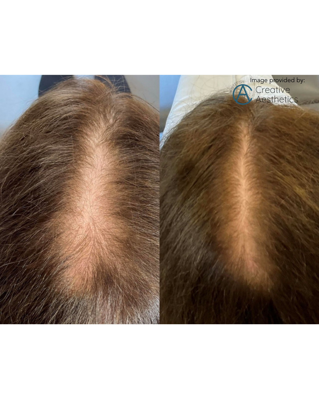 PDGF+ Hair Restoration (series of 3) + FREE High Frequency Wand