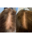 PDGF+ Hair Restoration (series of 3) + FREE High Frequency Wand