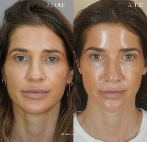 Sculptra